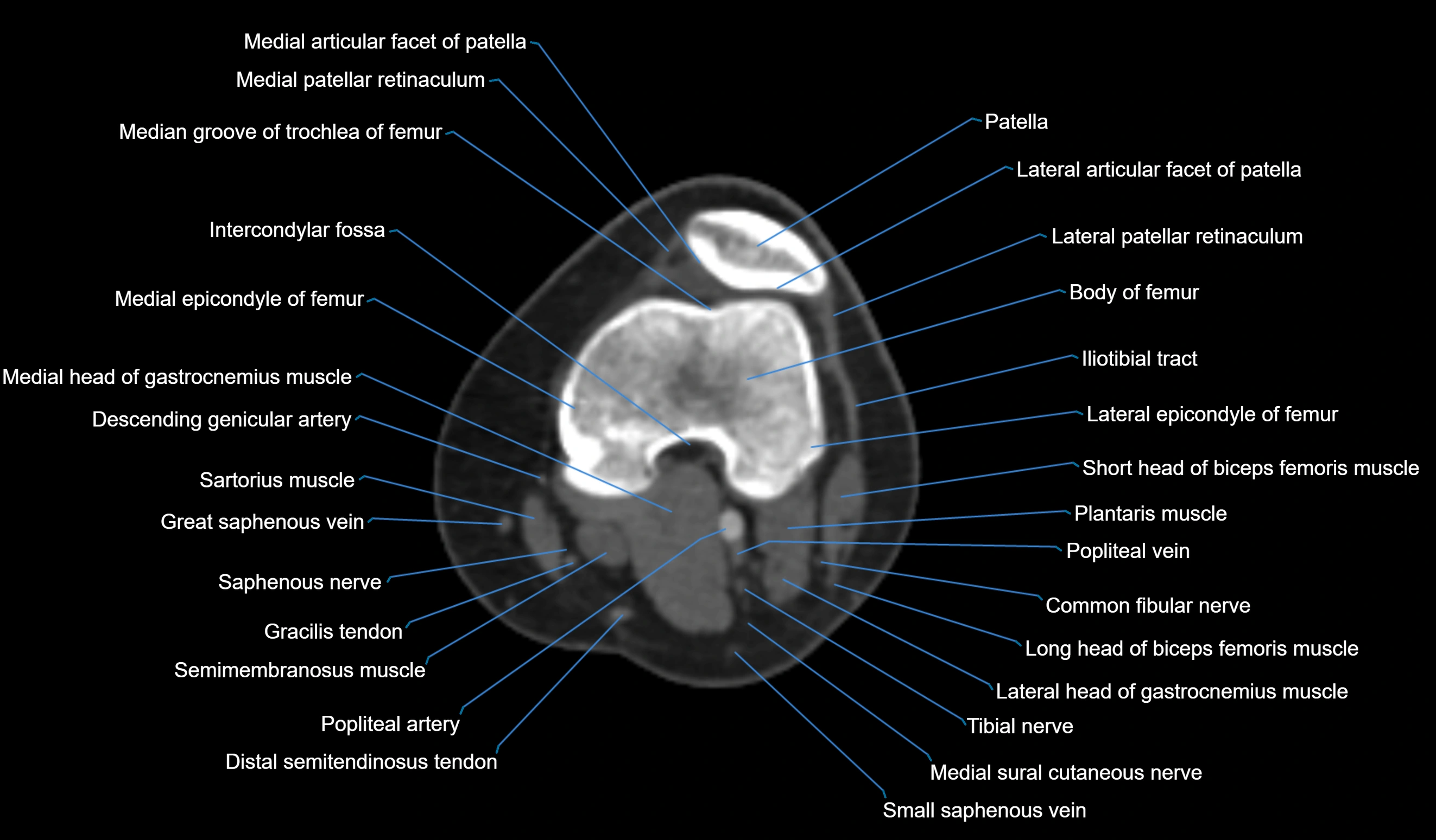 CT knee axial cross sectional anatomy labelled image-00025.webp